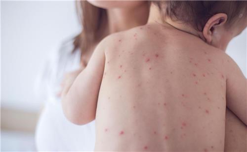 Chú ý: 3 triệu chứng mắc bệnh đậu mùa khỉ ở người